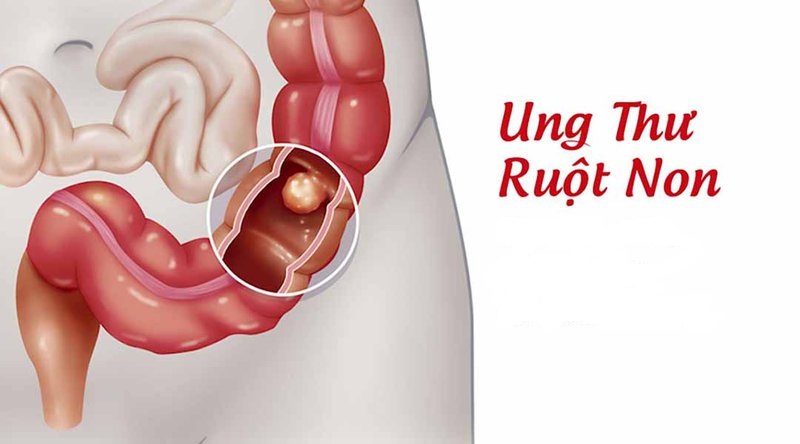 Một số bệnh lý đường ruột cũng ảnh hưởng tới tiêu hóa và hấp thu selen